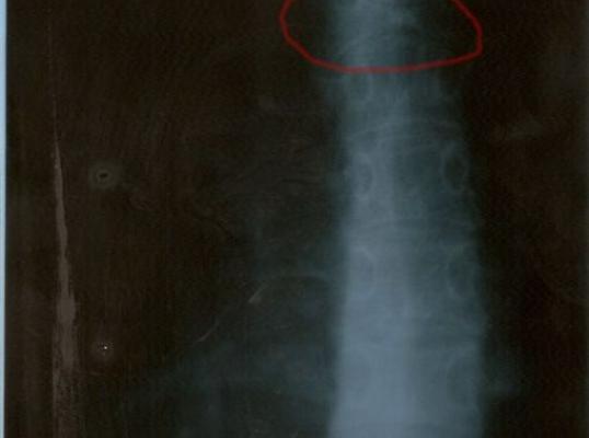 Фото для Врожденная аномалия развития позвоночника — требуются курсы мануальной терапии