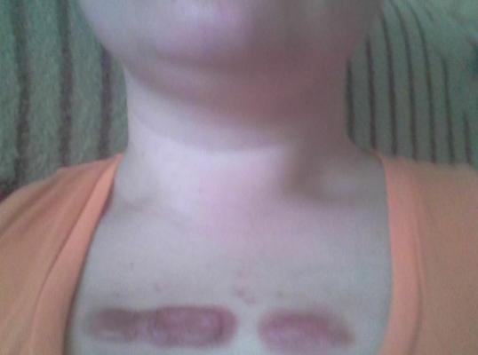 Фото для Нужна операция в области груди