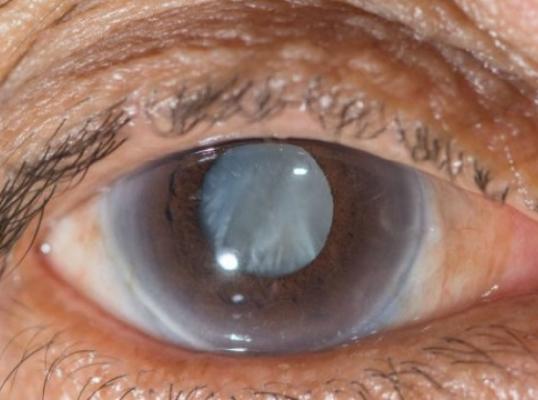 Фото для Вылечим катаракту пожилой женщине